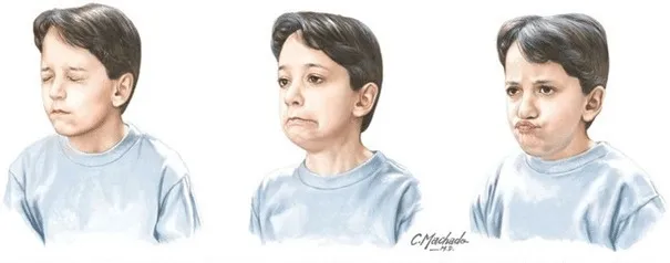 Kahramanmaraş Psikolog veya Terapi: Tik Bozuklukları